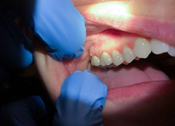 Best Emergency Dental Care for Sports Injuries in Versailles, KY